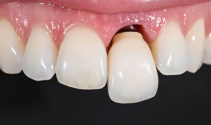 O dente do implante está mole