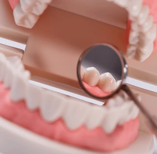 Quanto tempo dura uma coroa dentária? 1 Quanto tempo dura uma coroa dentária?
