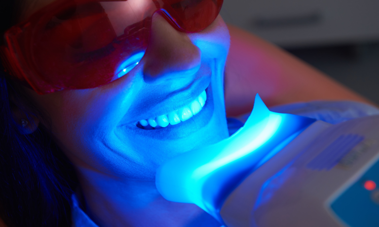 clareamento dental profissional vs caseiro