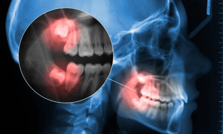 Saiba tudo sobre a extração do dente do siso: quando é necessária, como é feita e cuidados pós-operatórios. Agende sua consulta na Dentista VIP.