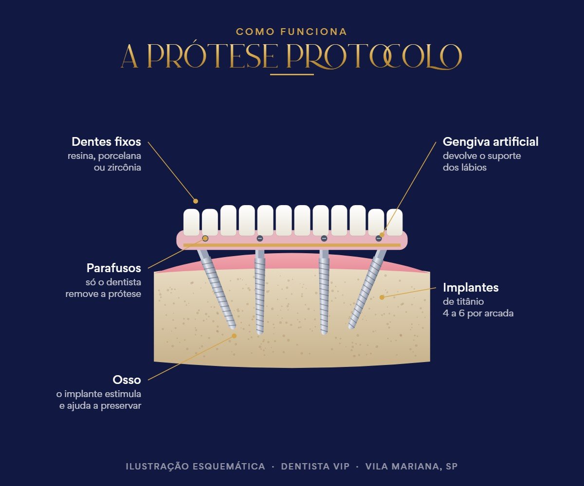 Ilustração de como funciona a prótese protocolo: dentes fixos parafusados sobre implantes de titânio