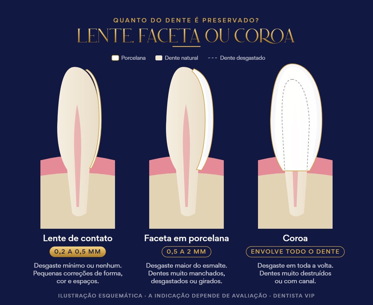 Ilustração comparando a espessura e o desgaste da lente de contato dental, da faceta em porcelana e da coroa